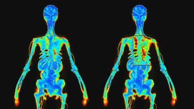 Bone Scan - Bone Scintigraphy