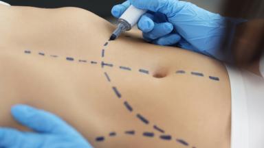 360 Body Liposuction