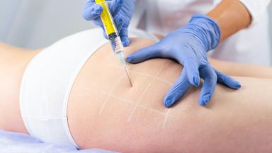 Brazilian Butt LIFT Surgery - BBL Surgery