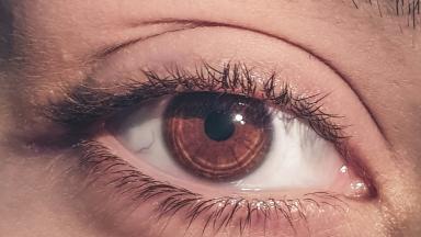 Blepharoplasty - Eyelid Surgery