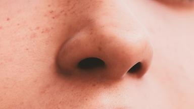 Nasal Polyp Surgery