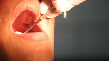 Tonsillectomy - Tonsil Removal Surgery