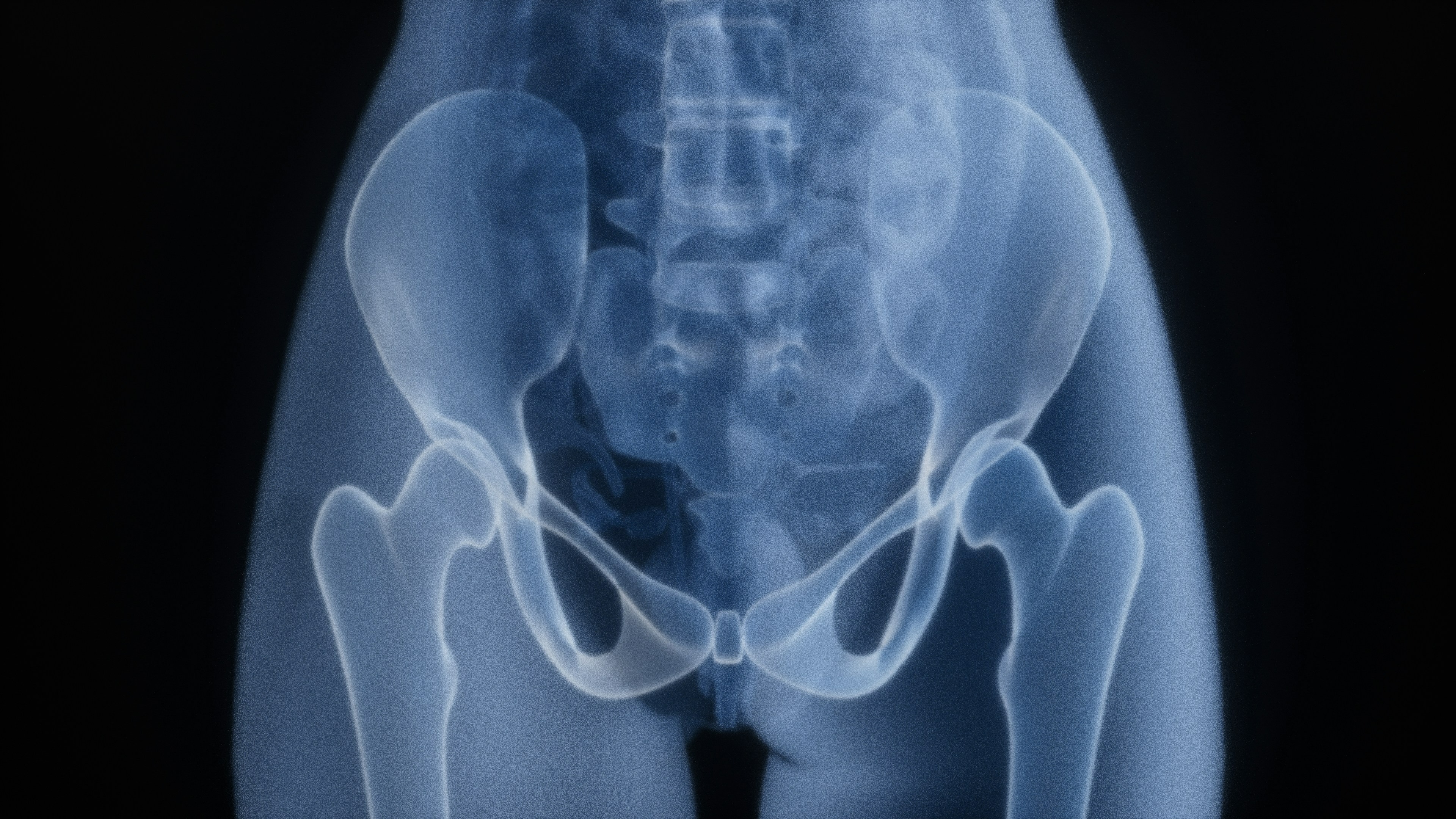 Sacral Tumor Surgery