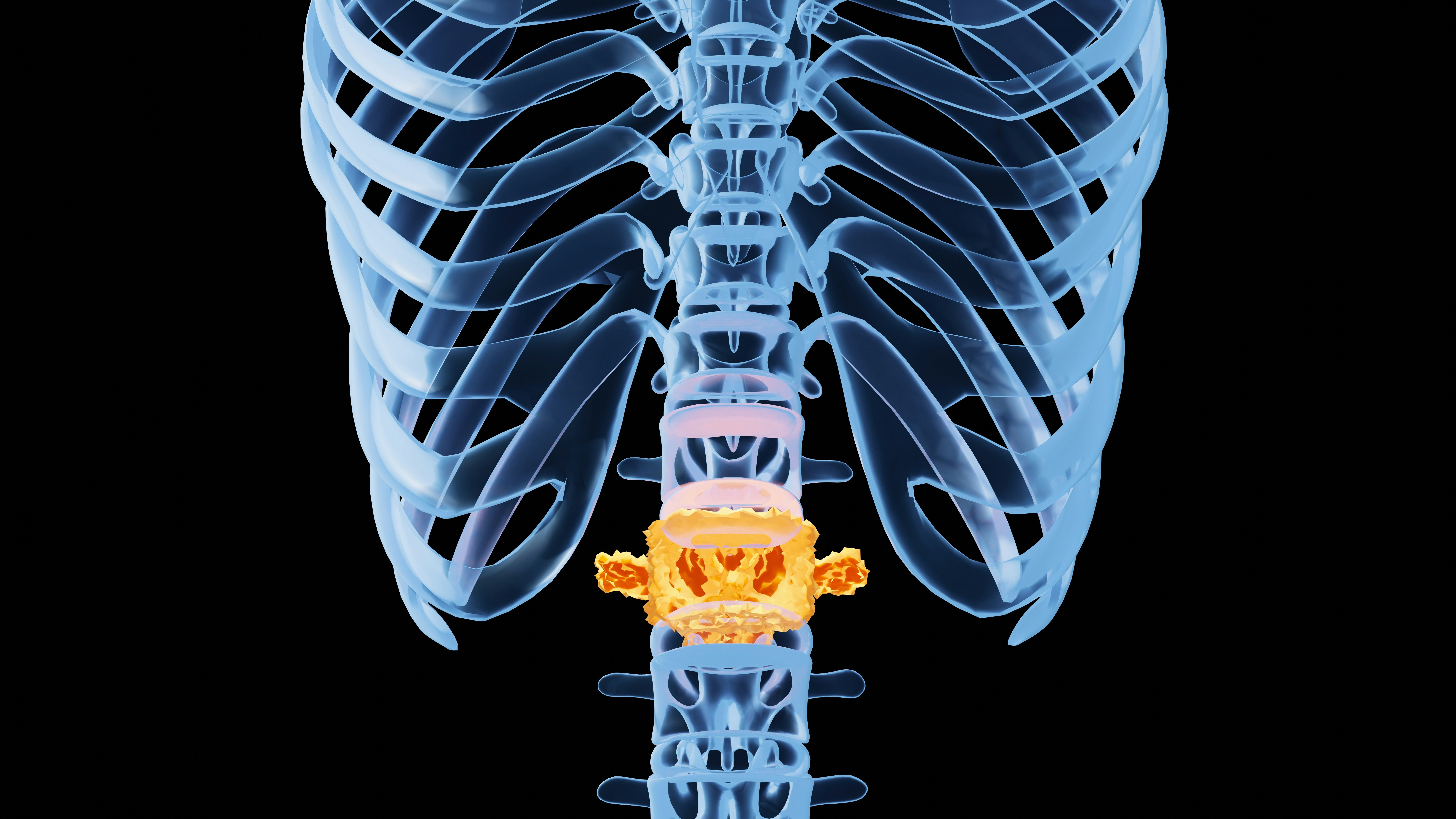 Herniated Disc - Slipped Disc Surgery