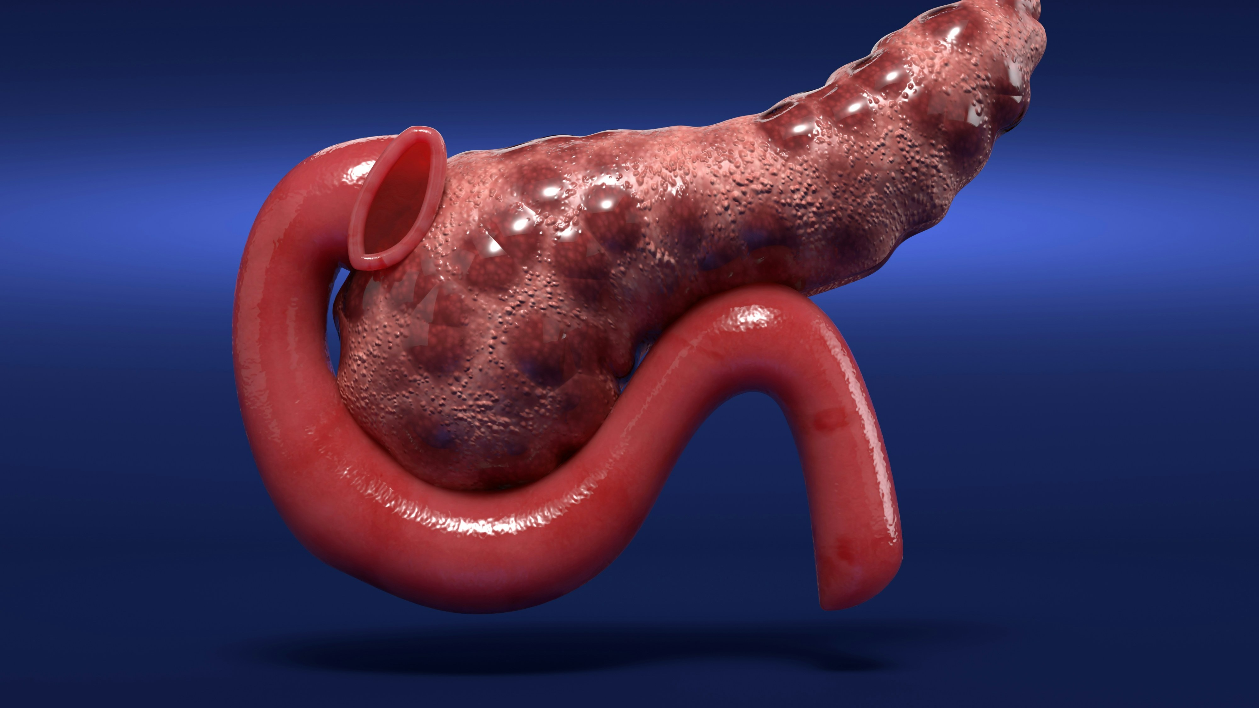 Liver Cancer Surgery