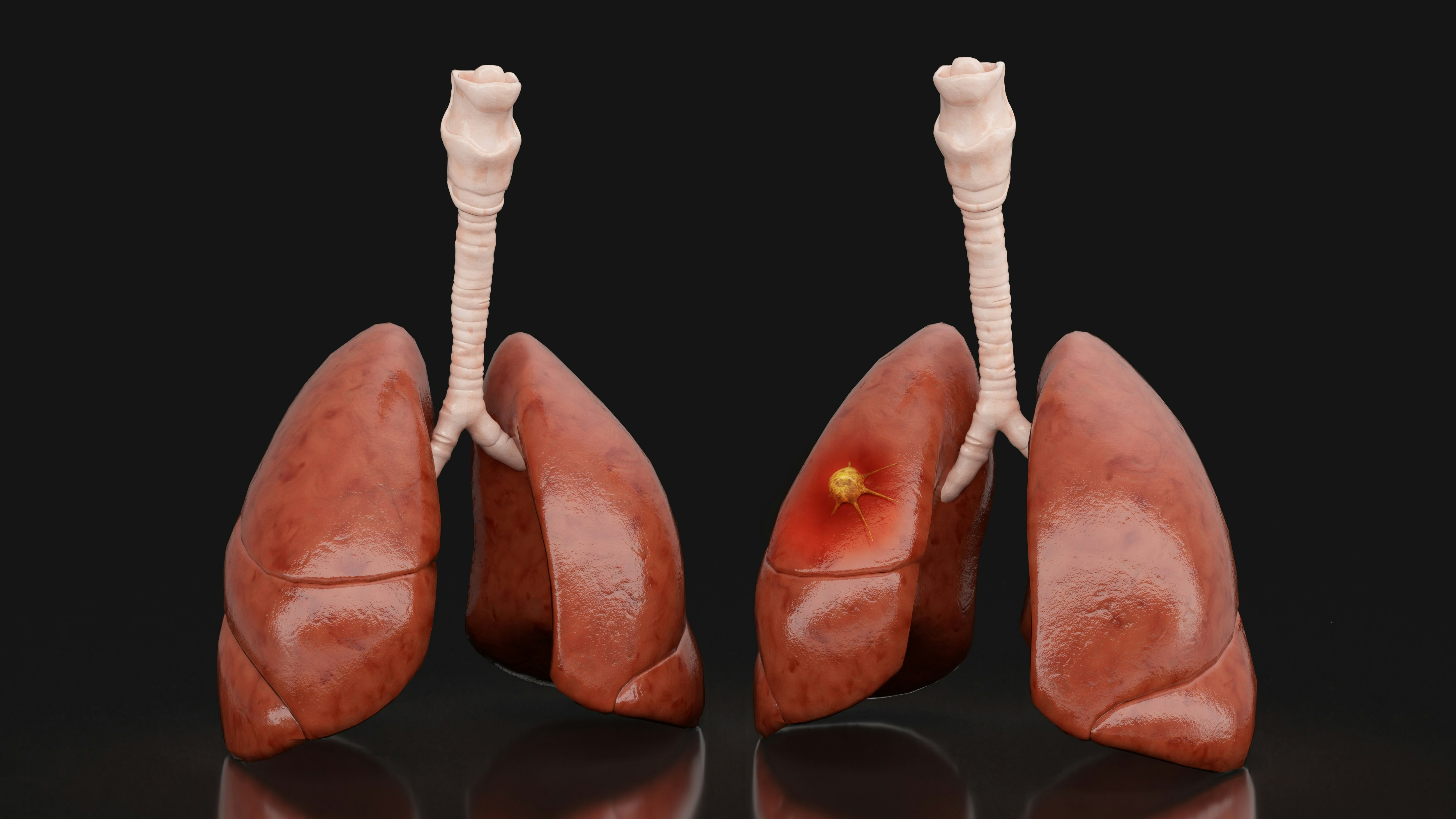 Lung Cancer Surgery