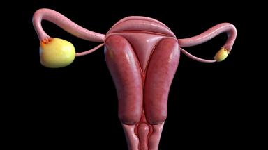 Debulking - Ovarian Cancer Tumor Reduction