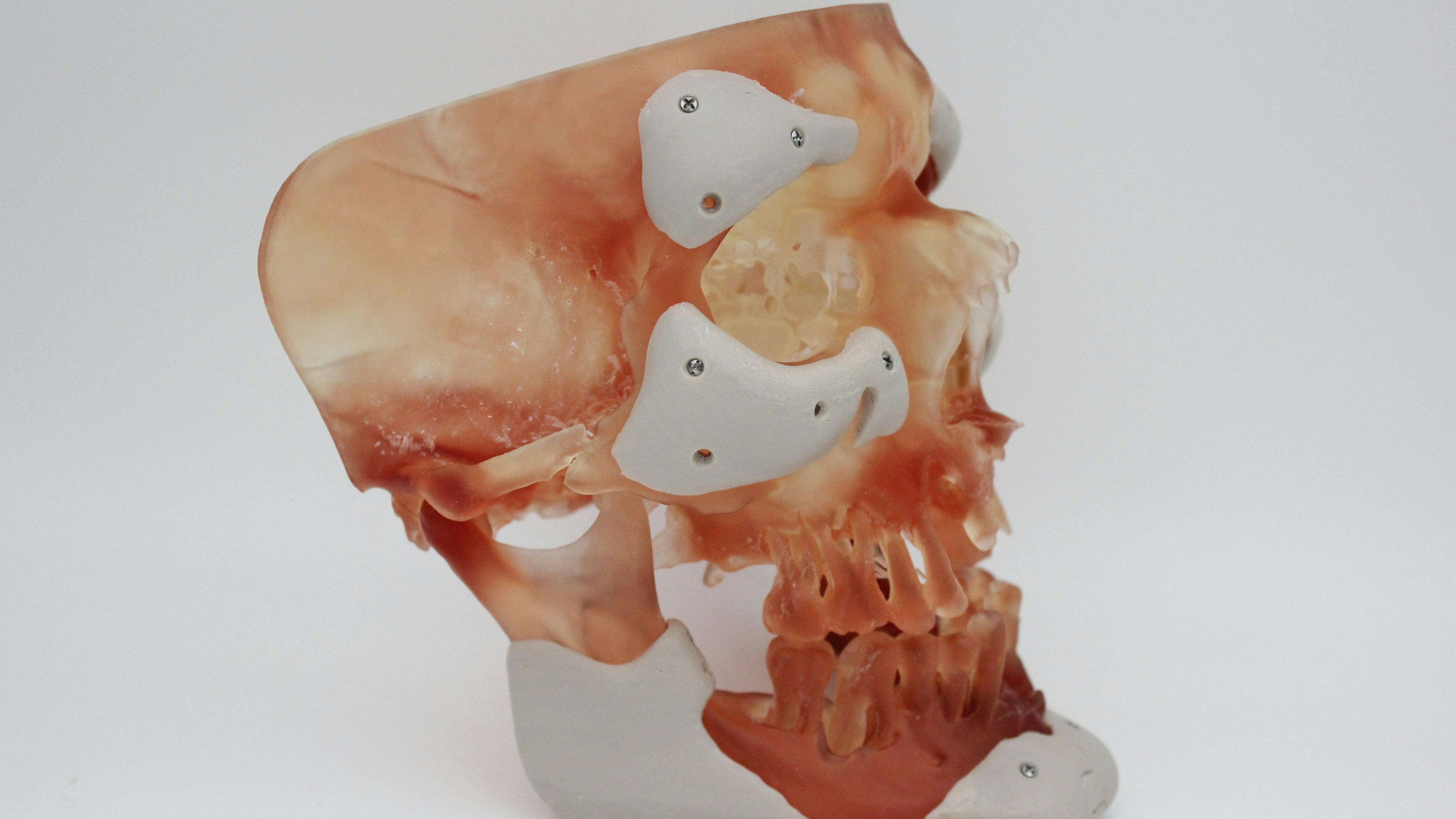 Bone Tumor Resection