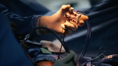 Minimally Invasive CABG (MIDCAB)
