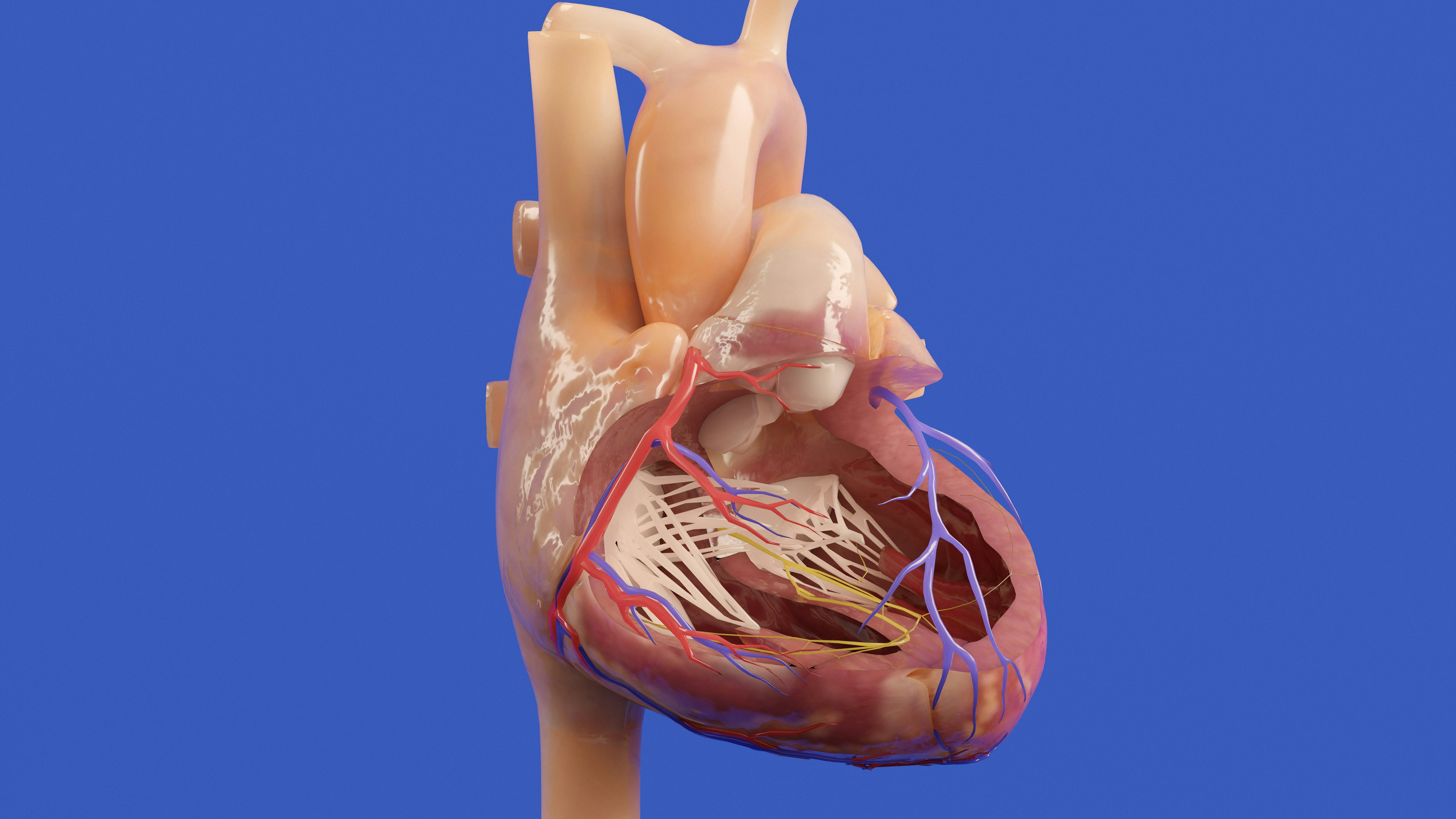 Mitral Valve Replacement