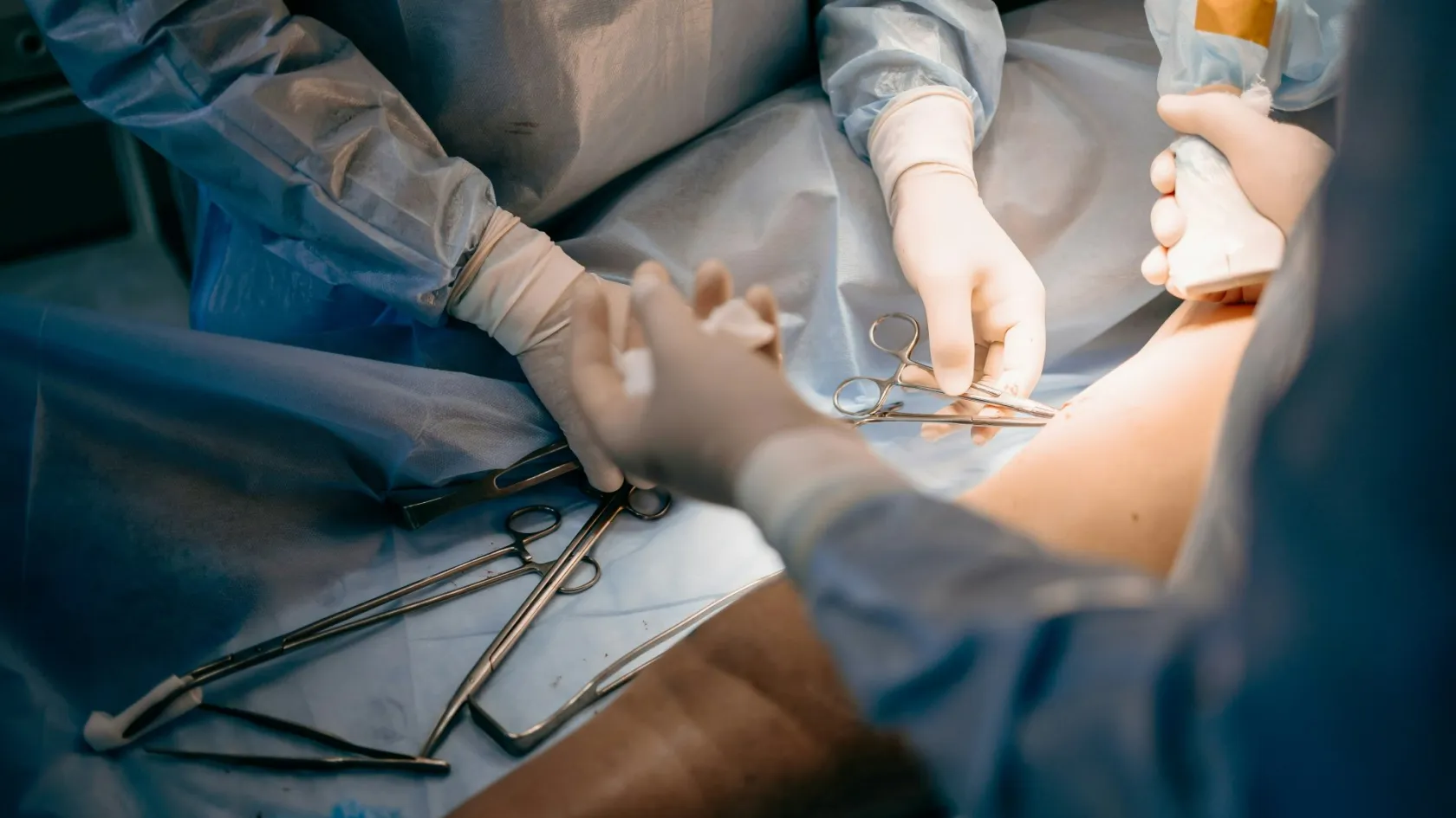 Free Flap Reconstruction