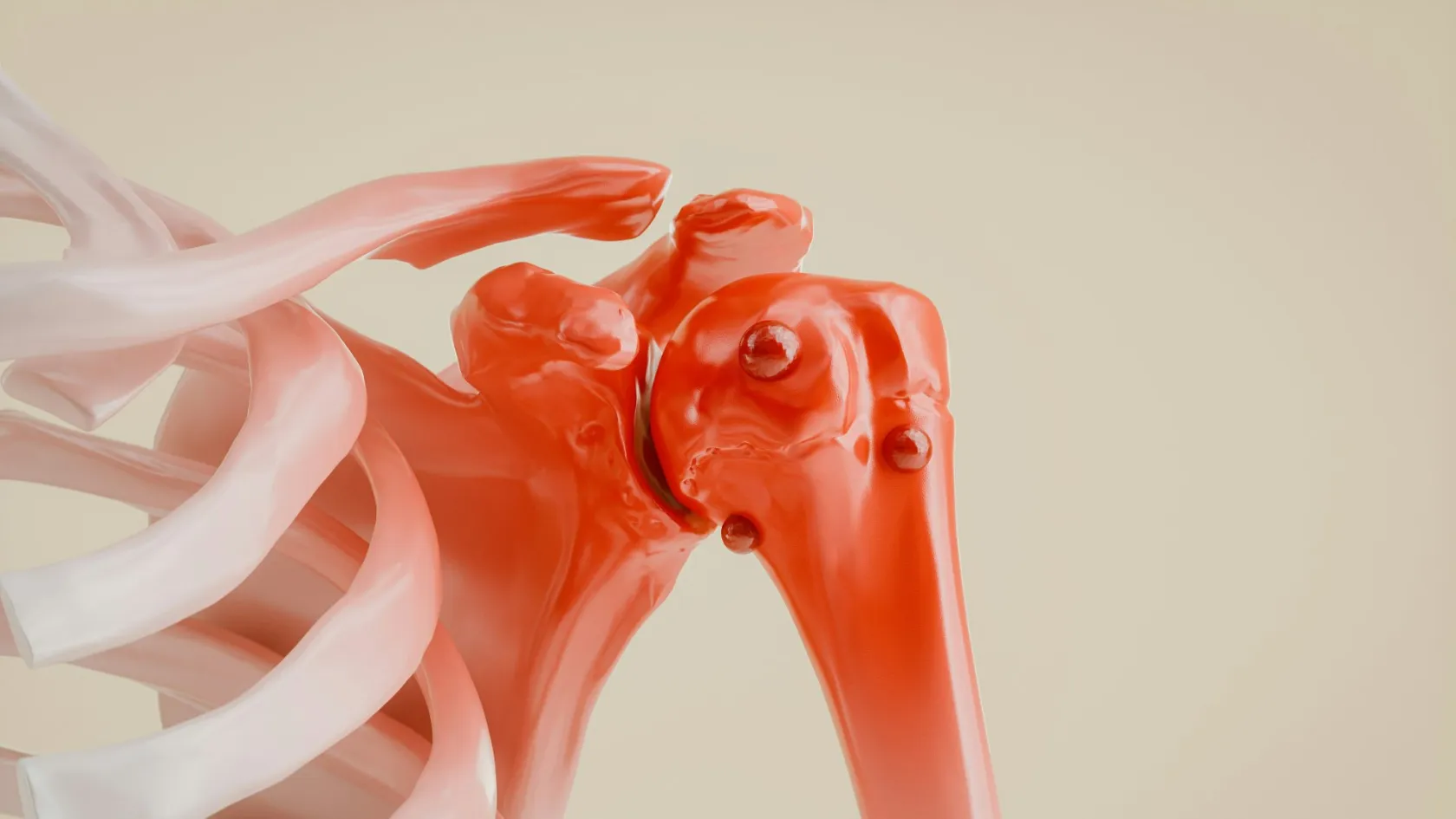 Chondrosarcoma Surgery and Bone Tumor Resection