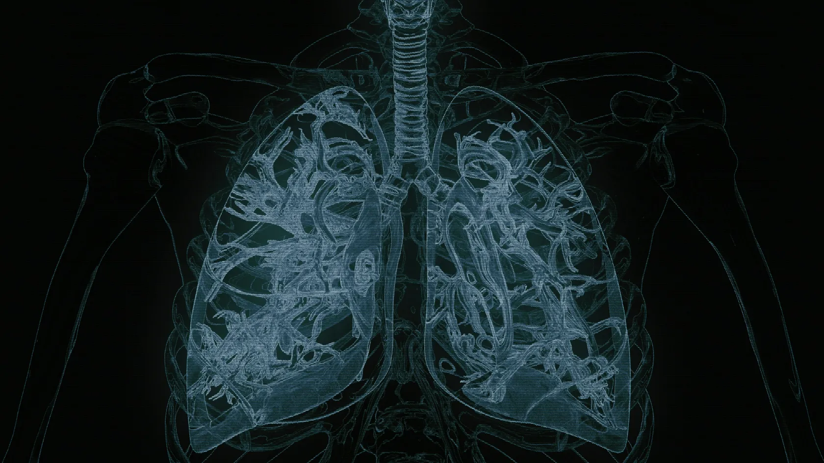 Lung Cancer Radiation Therapy