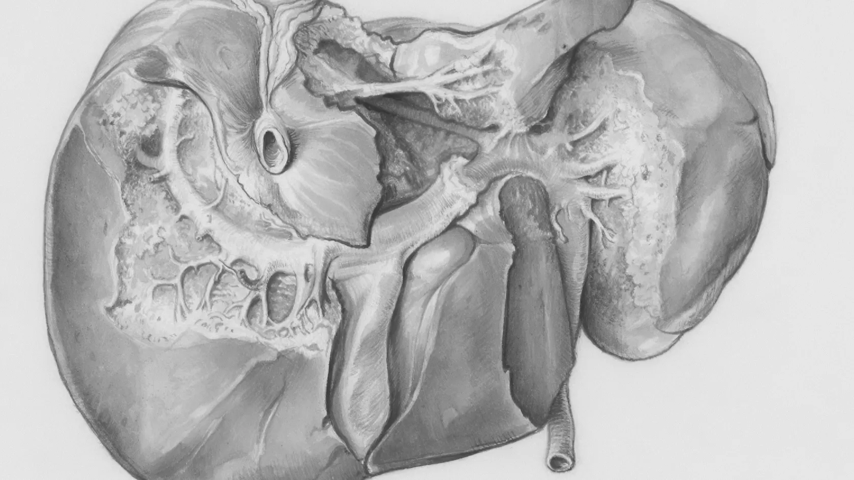 Liver Cancer Radiation Therapy
