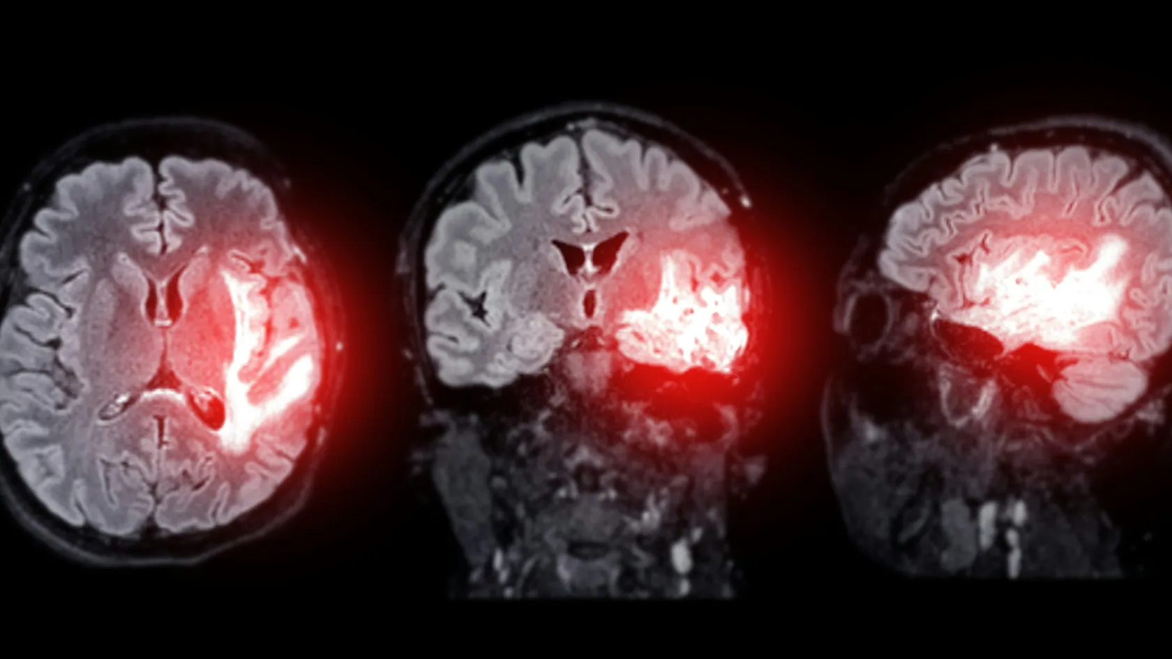 Palliative Radiation Therapy