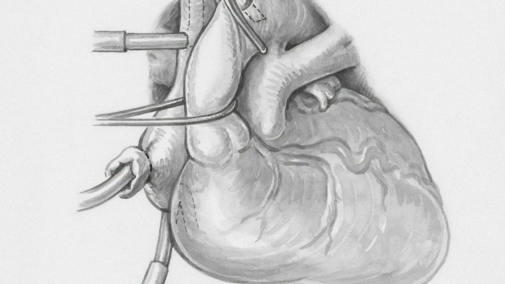 RFA - Radiofrequency Ablation