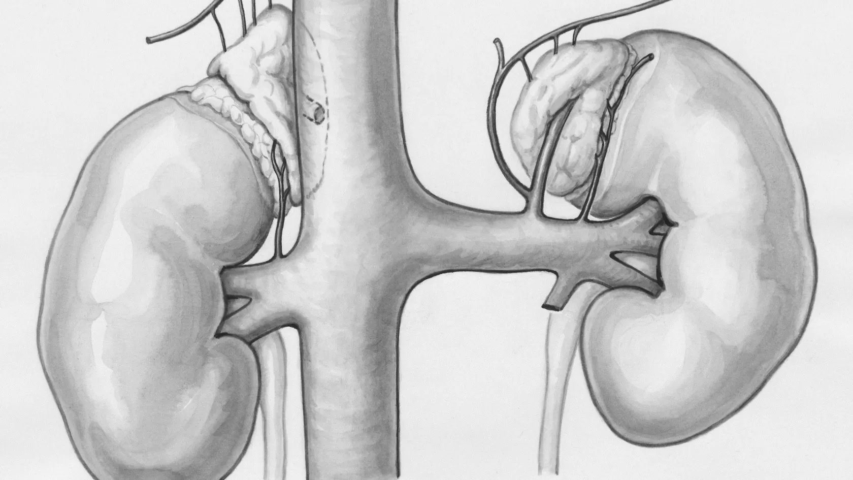 PTBD - Percutaneous Transhepatic Biliary Drainage
