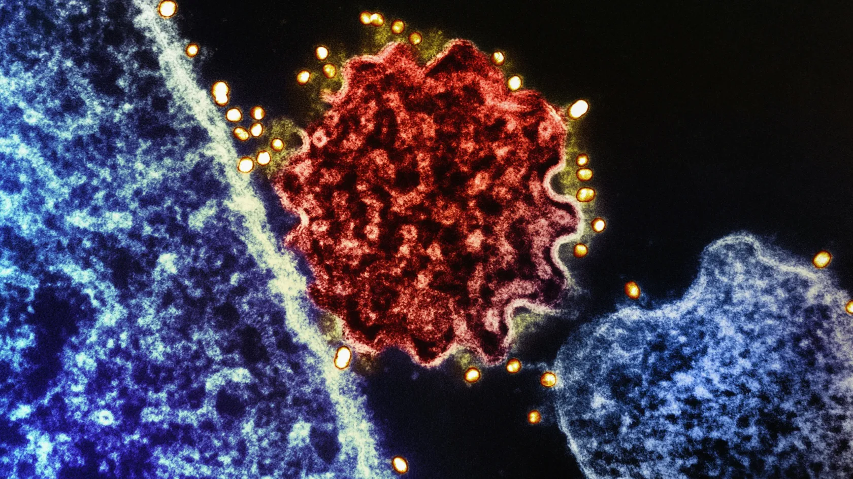 Nivolumab Therapy - Opdivo