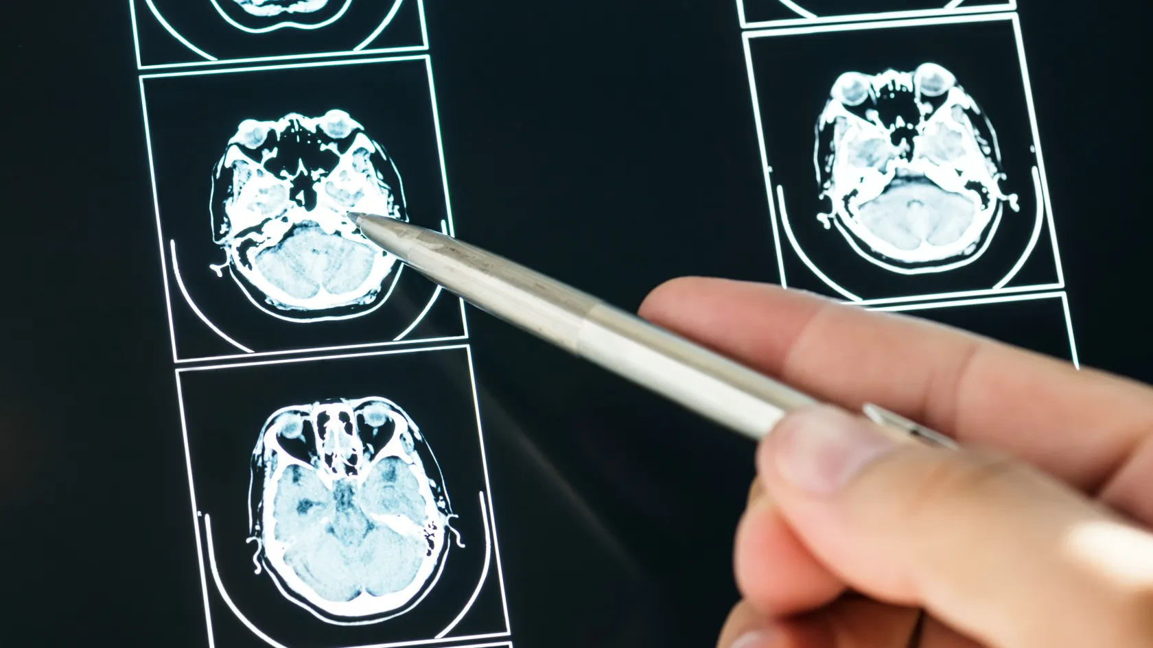 Dotatate PET/CT Scan - Neuroendocrine Tumor Imaging