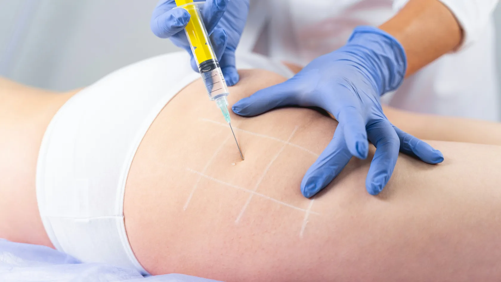 Brazilian Butt LIFT Surgery - BBL Surgery