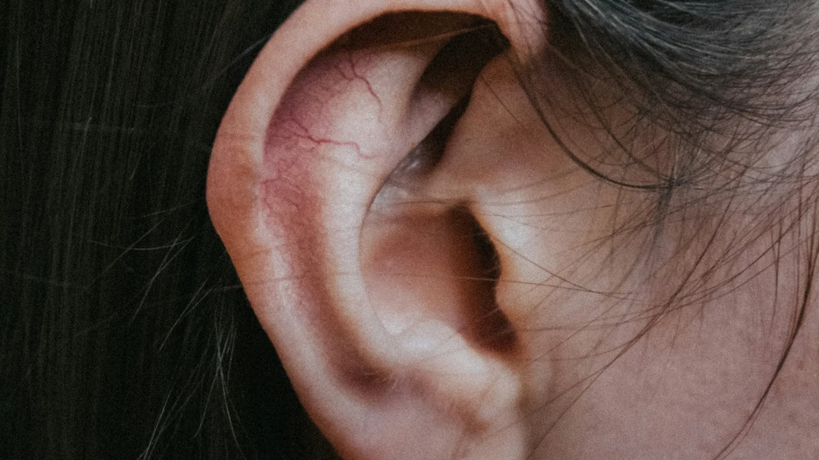 Otoplasty